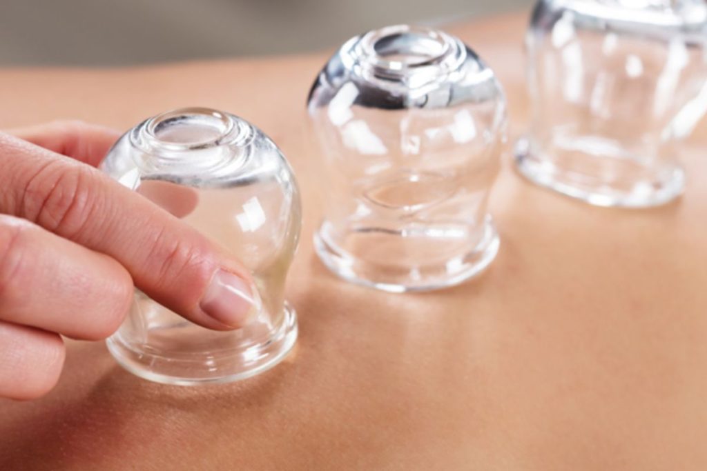 cupping on back