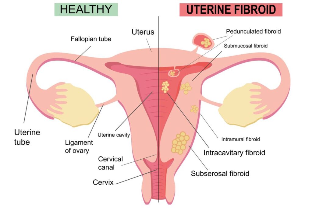 Diagram of a woman's uterus and uterine fibroids