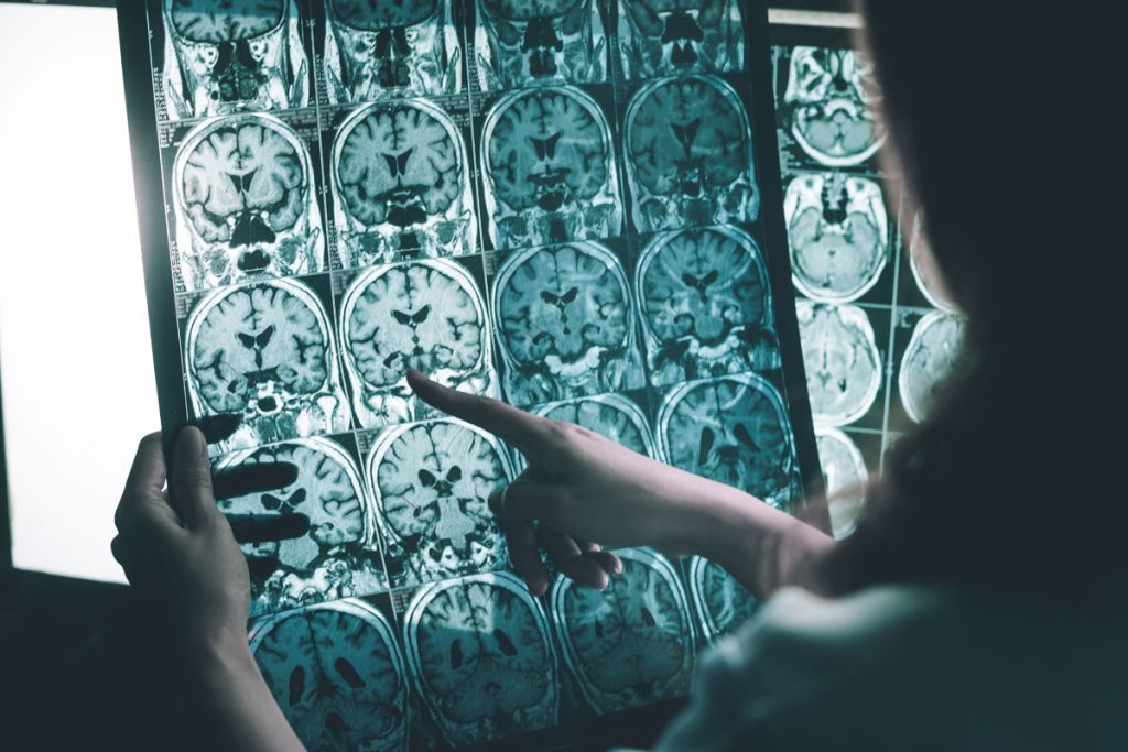 brain image with doctor looking for dementia