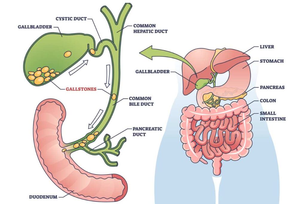 diagram of gallstones and stomach