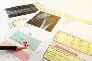 Printout of T-Scores for osteoporosis