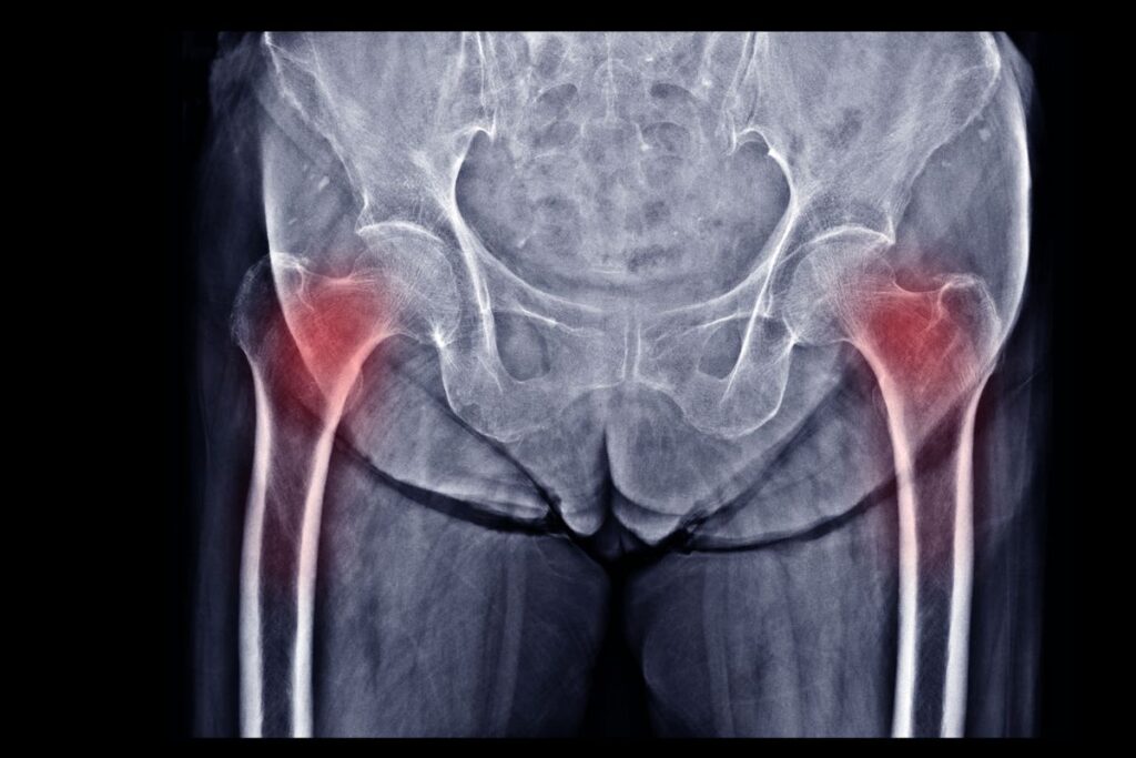 xray showing osteoporosis in hips