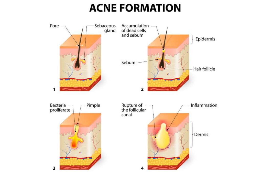Acne formation visual image