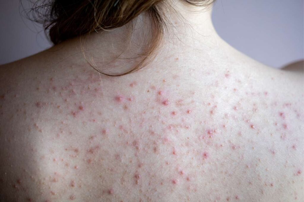 Acne on a woman's back
