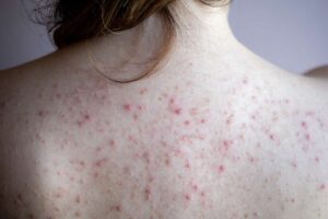 Acne on a woman's back