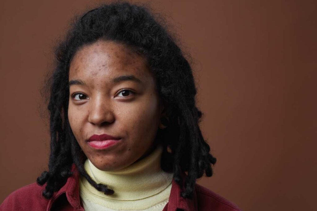 Acne on a black woman's forehead during menopause