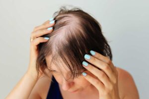 menopausal woman with hair loss at top of head