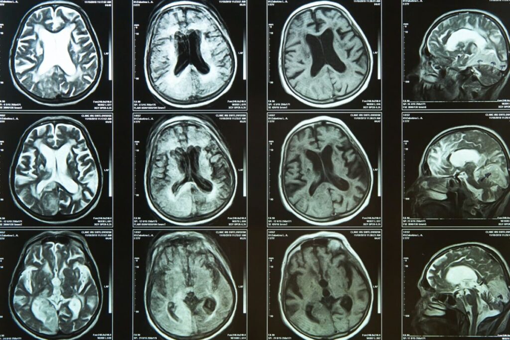 Brain scan images for Alzheimers